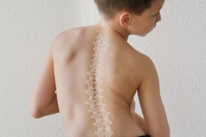 العلاج الطبيعي للجنف